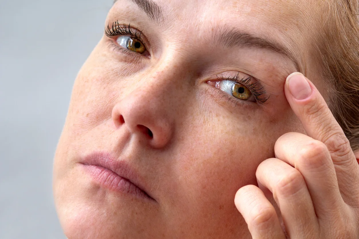 Resultado antes y después de blefaroplastia sin cirugía en BCNClinic