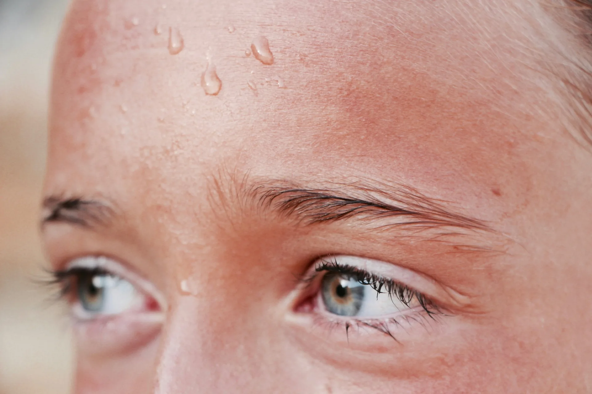 Aplicación de toxina botulínica para tratar hiperhidrosis en axilas en BCNClinic Barcelona