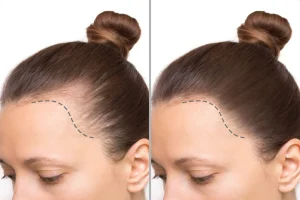 Antes y después de injerto capilar femenino